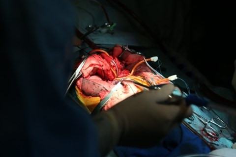 手术进行过程中（图片来源：103军医学院提供）