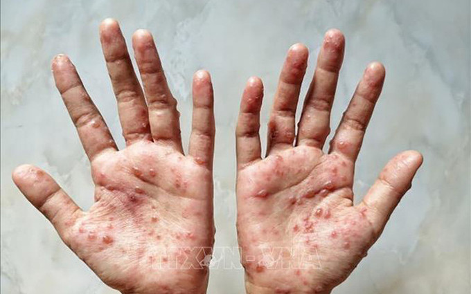 越南卫生部提出六大预防猴痘措施。图自越通社 越南卫生部提出六大预防猴痘措施 ảnh 1