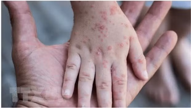 世卫组织驻越代理首席代表：提升猴痘病毒的监测和诊断能力 做好猴痘疫情防控应对工作 ảnh 2